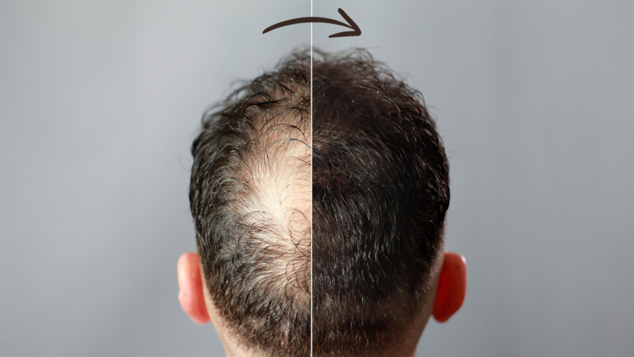 Hair Transplant UK – Expert Surgeons, Proven Techniques