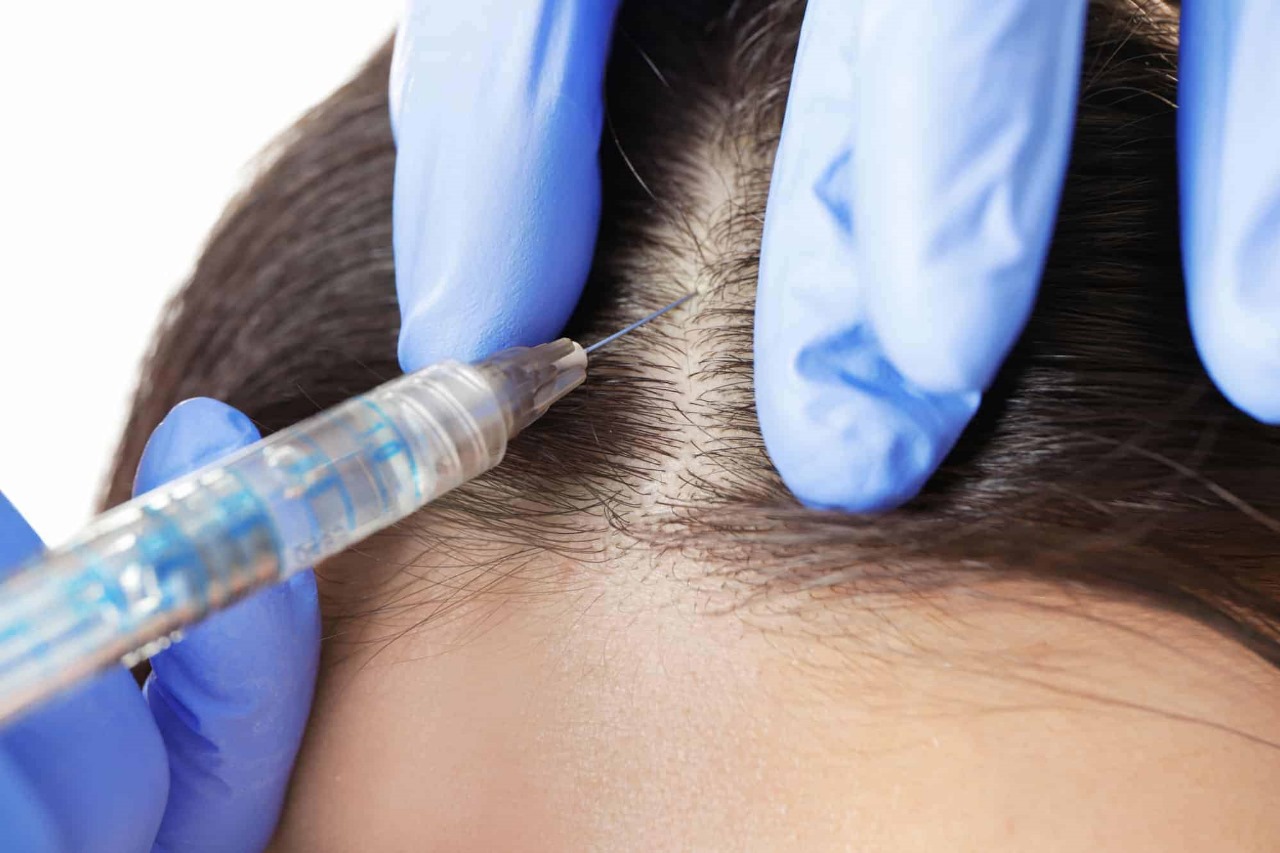 Hair Transplant – Affordable, Effective, and Discreet