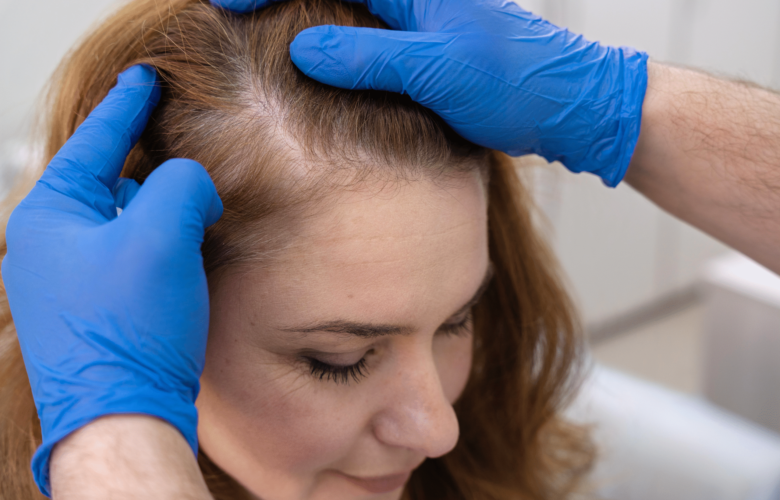 Hair Transplant Turkey Cost vs Quality: Why Patients Travel Abroad